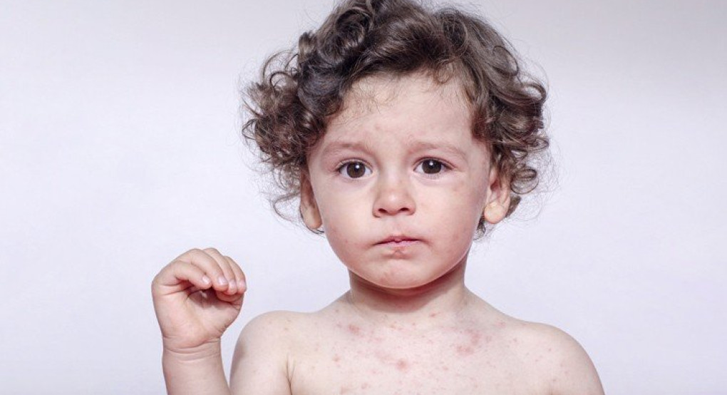 Θερίζει τη Σαμόα η ιλαρά, έκλεισαν τα σχολεία