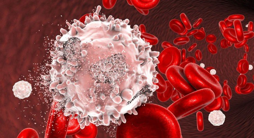  Έλληνας ερευνητής συμμετείχε στη δημιουργία ενός συστήματος αξιόπιστων διαγνώσεων λευχαιμίας