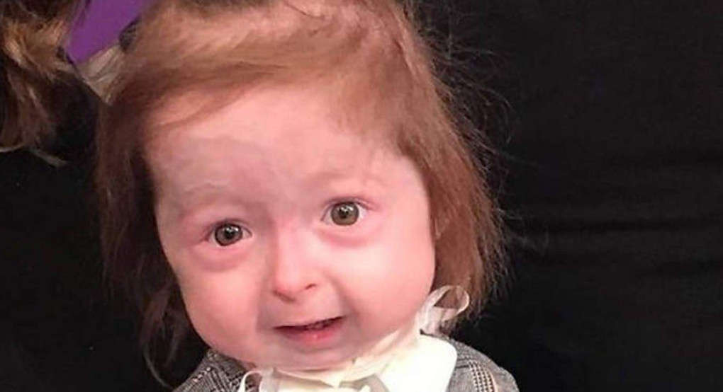 Από σπάνια ασθένεια πάσχει 2χρονο κοριτσάκι που την γερνάει πρόωρα