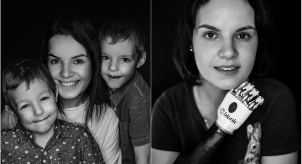 Όταν κατήγγειλε τον άνδρα της για βία εκείνος της έκοψε τα χέρια με τσεκούρι-Σήμερα αποτελεί πρότυπο δύναμης