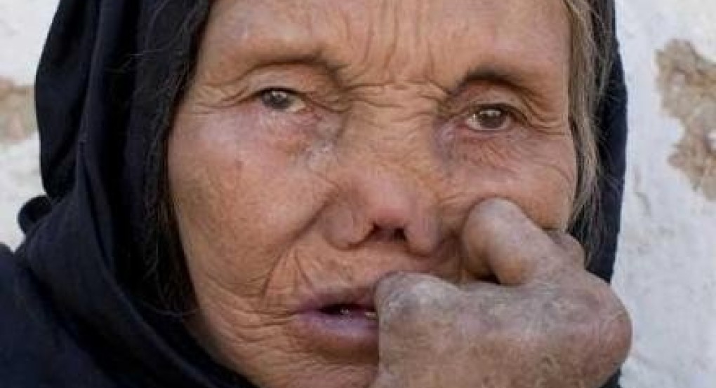 Παγκόσμια Ημέρα κατά της Λέπρας