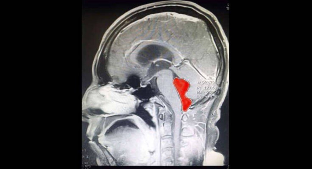 Σκουλήκι ήταν στον εγκέφαλο ανθρώπου για 10 χρόνια-Αφαιρέθηκε με επιτυχία