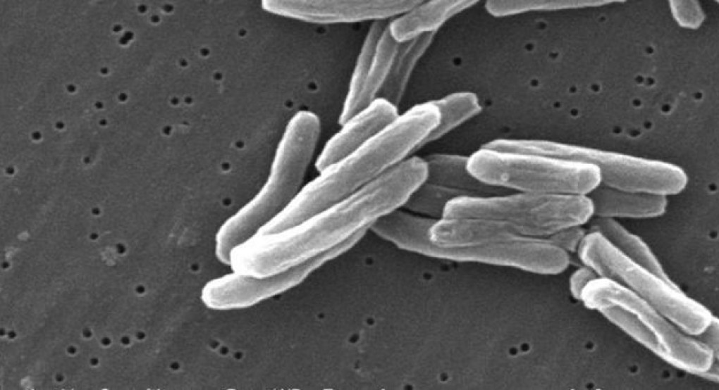 Παγκόσμια Ημέρα κατά της Φυματίωσης 