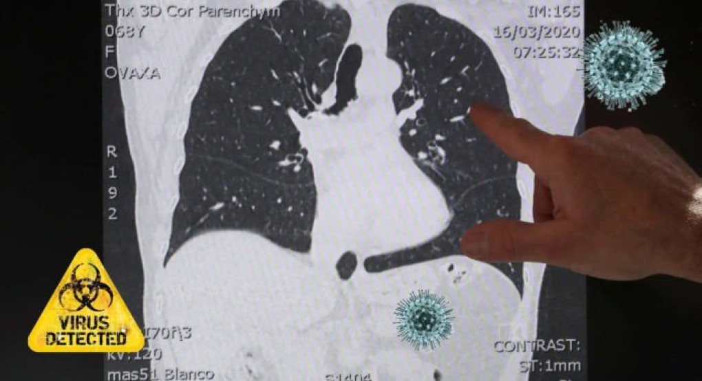 Κορωνοϊός: Πώς ο Covid-19 διαλύει τα πνευμόνια -4 κατηγορίες ασθενών