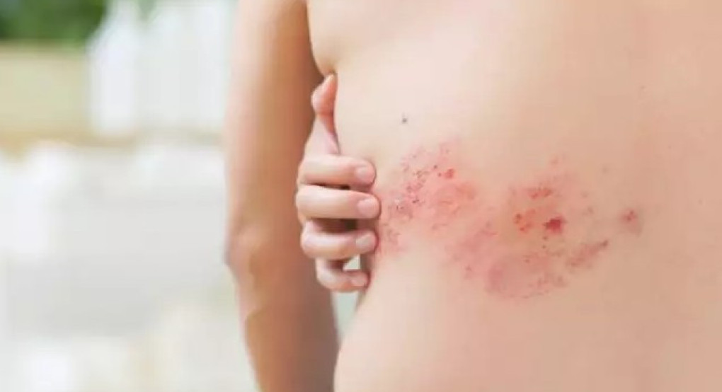 Έδεσσα: Ενημερωτική ομιλία «Ζω με Ποιότητα, Προλαμβάνω τον Έρπητα Ζωστήρα»