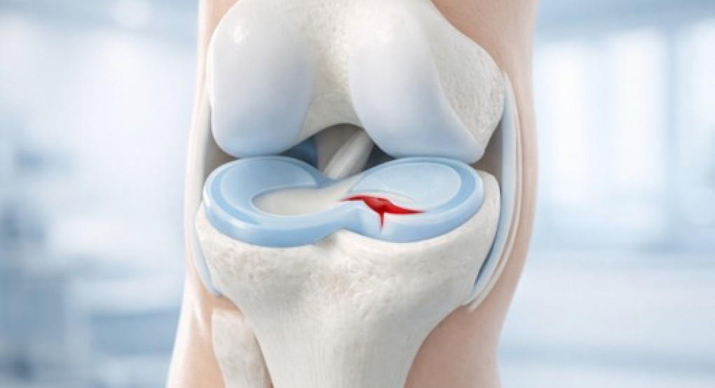 Ρήξη Μηνίσκου και Αρθροσκόπηση Γόνατος: Διάγνωση, Θεραπεία και Αποκατάσταση