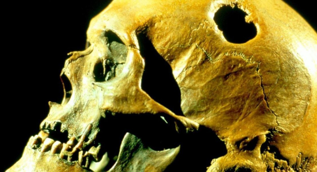 Γιατί είχαν τρύπες τα κεφάλια των Αρχαίων Ελλήνων; - Τι ανακάλυψαν οι επιστήμονες;