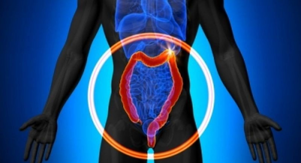 Περισσότερο φως από Έλληνες επιστήμονες του ερευνητικού κέντρου «Φλέμιγκ» και του Πανεπιστημίου Yale των ΗΠΑ για τον καρκίνο του εντέρου