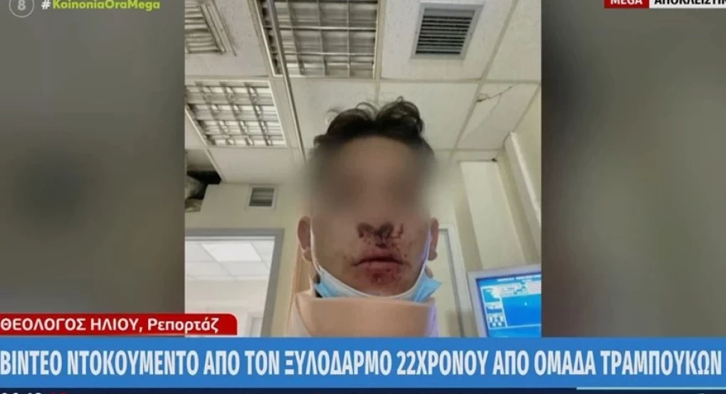 Θεσσαλονίκη: Ξυλοκοπήθηκε άγρια 22χρονος – Κατήγγειλε ότι τον χτύπησαν 10 άτομα Θεσσαλονίκη: Ξυλοκοπήθηκε άγρια 22χρονος – Κατήγγειλε ότι τον χτύπησαν 10 άτομα