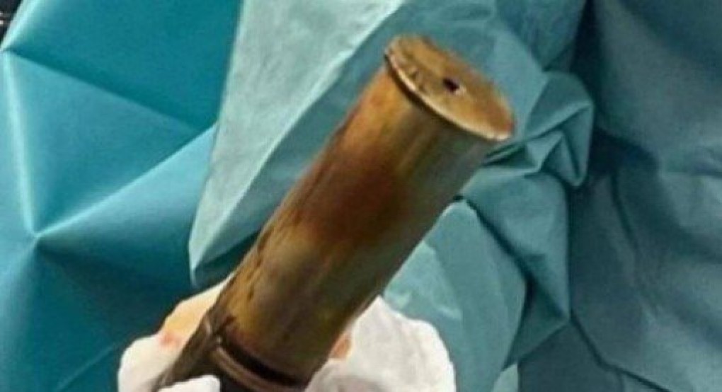 Πήγε στα επείγοντα με οβίδα του Α’ Παγκοσμίου στον πρωκτό του – Εκκενώθηκε γαλλικό νοσοκομείο