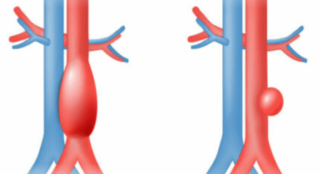 Δωρεάν διαγνωστικός έλεγχος για την προσυμπτωματική ανίχνευση του ανευρύσματος της κοιλιακής αορτής