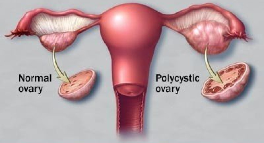  Πολυκυστικές ωοθήκες και διατροφή