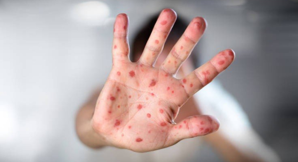  Η ιλαρά κάνει κακό στην υγεία μας με περισσότερους τρόπους απ’ όσους νομίζαμε