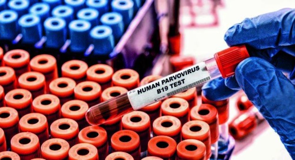 Παρβοϊός Β19: Tα συμπτώματα, η μετάδοση και τα μέτρα πρόληψης
