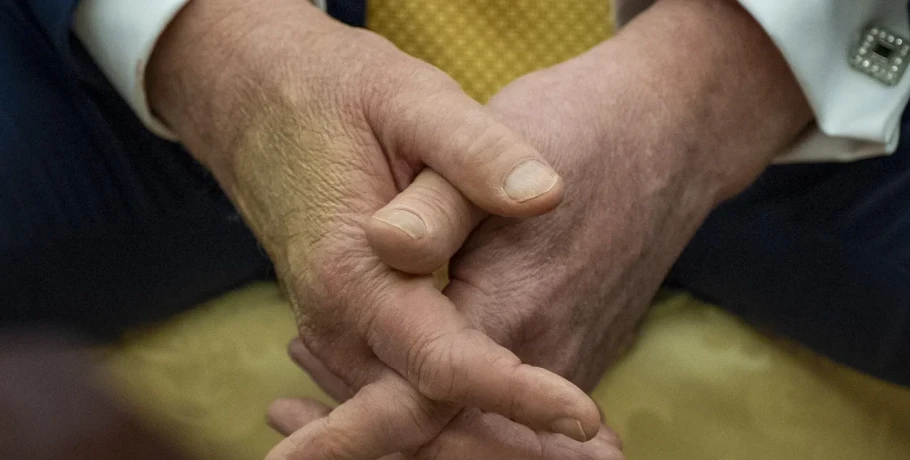 Ο Τραμπ διαγνώστηκε με χρόνια φλεβική ανεπάρκεια -Τι σημαίνει, συμπτώματα, αιτίες και θεραπεία