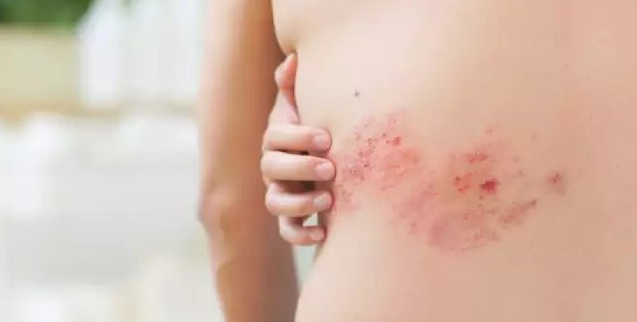 Έδεσσα: Ενημερωτική ομιλία «Ζω με Ποιότητα, Προλαμβάνω τον Έρπητα Ζωστήρα»