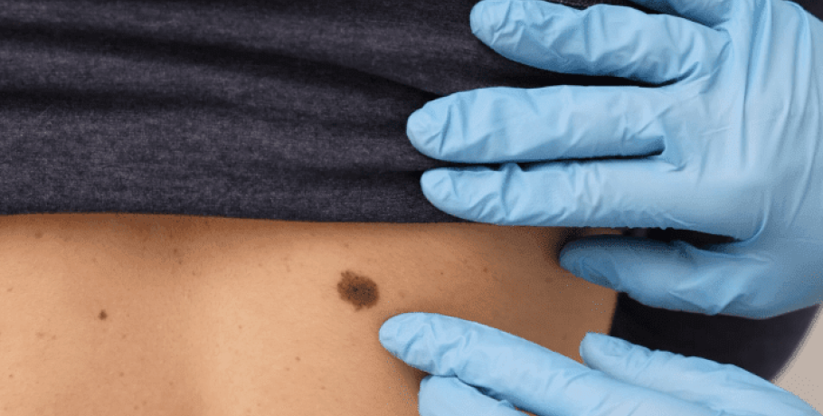 Μελάνωμα: Ελπίδες για πειραματικό εμβόλιο mRNA κατά του καρκίνου – Εκτόξευση των μετοχών Merck και Moderna