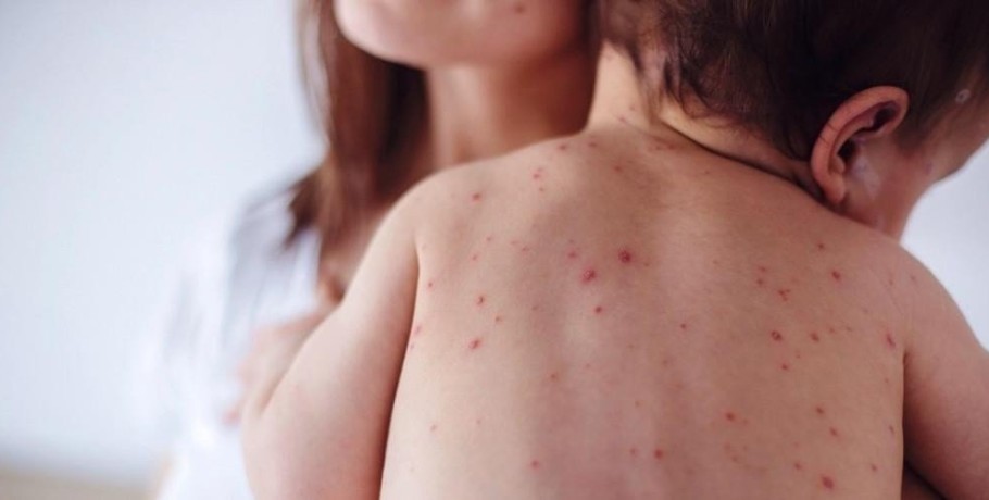 O φόβος της ιλαράς επιστρέφει: Παγκόσμιος συναγερμός - Εκατομμύρια παιδιά ευάλωτα λόγω χαμένων εμβολίων
