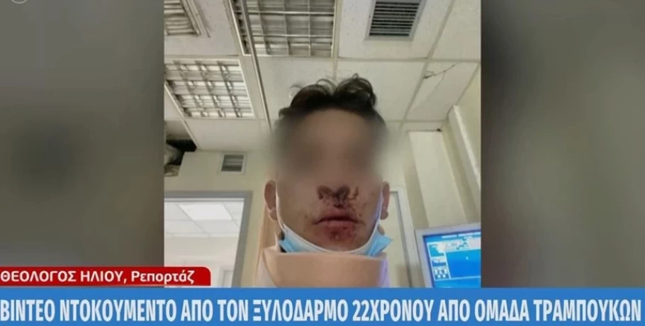 Θεσσαλονίκη: Ξυλοκοπήθηκε άγρια 22χρονος – Κατήγγειλε ότι τον χτύπησαν 10 άτομα