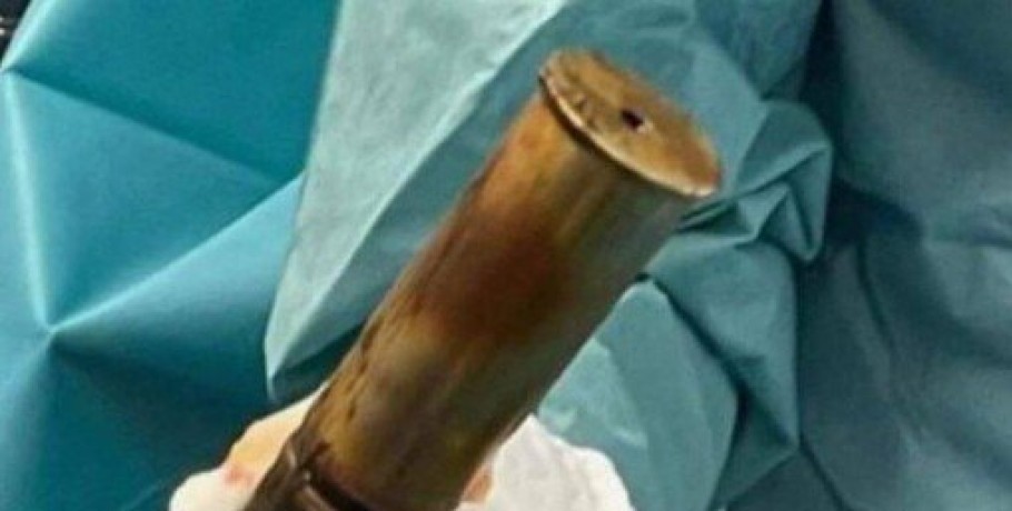 Πήγε στα επείγοντα με οβίδα του Α’ Παγκοσμίου στον πρωκτό του – Εκκενώθηκε γαλλικό νοσοκομείο